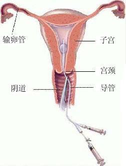 通草功效揭秘，疏通输卵管堵塞的神奇作用（极速版6.18）