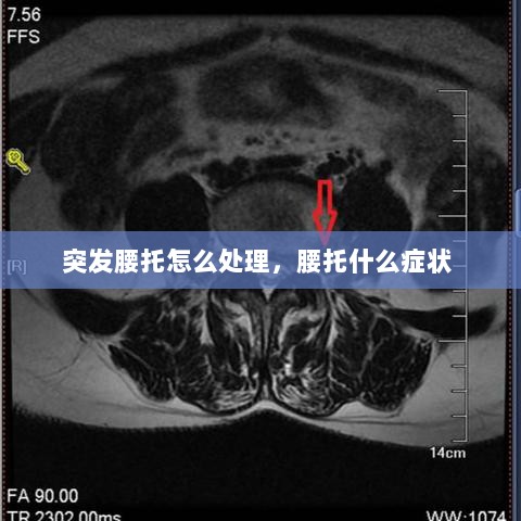 突发腰托怎么处理，腰托什么症状 