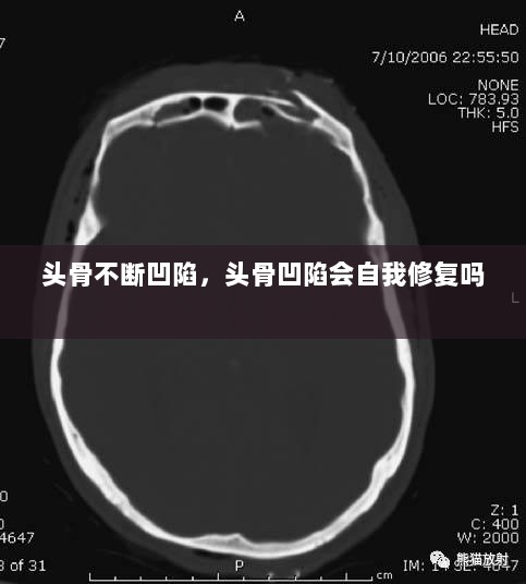 头骨不断凹陷，头骨凹陷会自我修复吗 